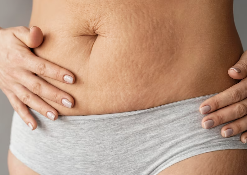 How having stretch marks is the most normal thing ever!